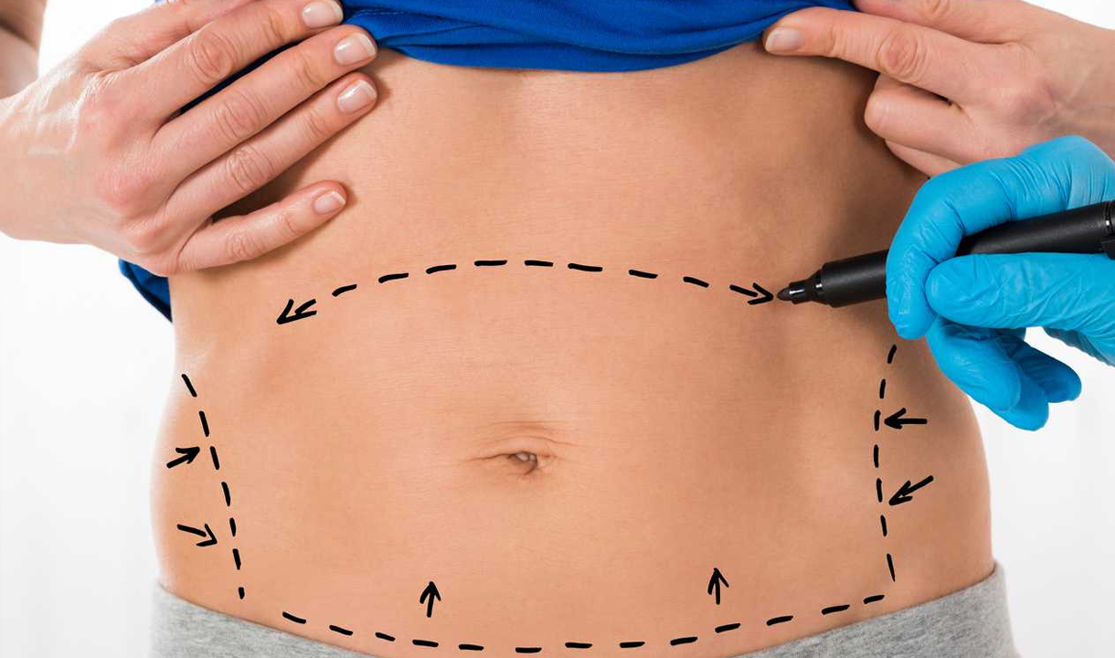 abdominoplasti
